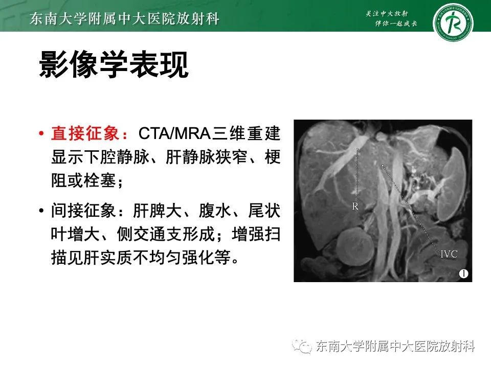 影像PPT - 【PPT】布加综合征-15