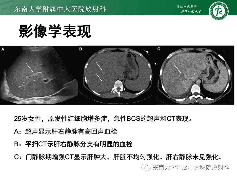 影像PPT - 【PPT】布加综合征-17