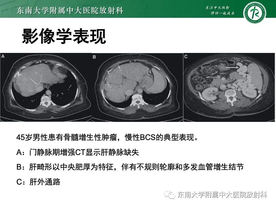 影像PPT - 【PPT】布加综合征-18
