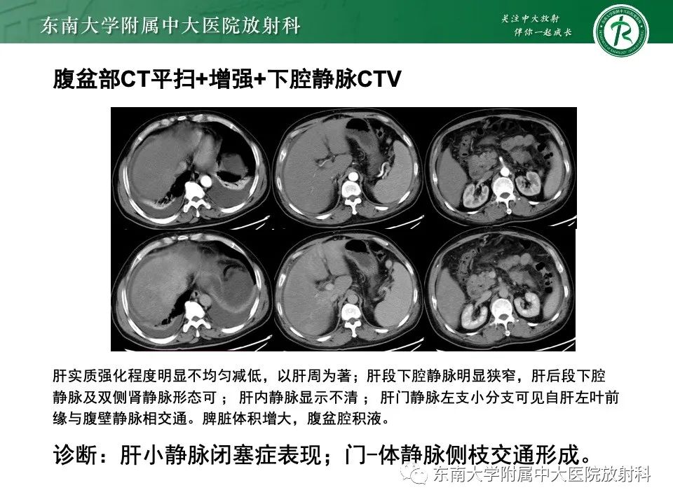影像PPT - 【PPT】布加综合征-23