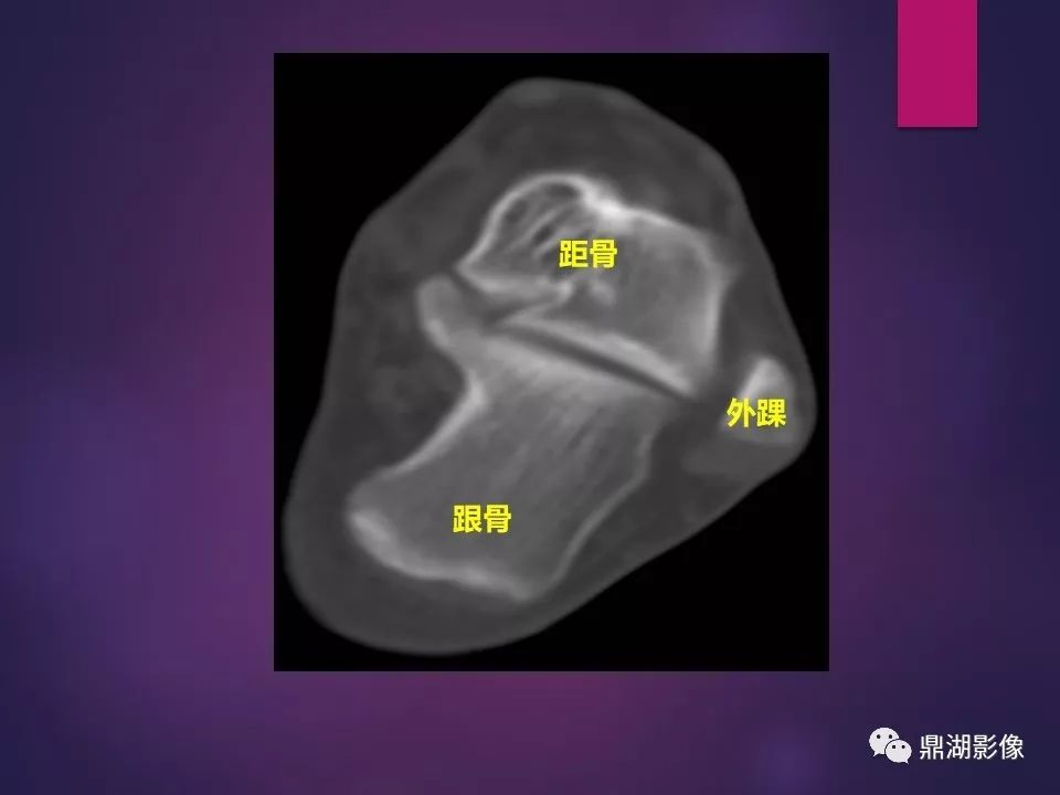 影像PPT - 【PPT】骨骼肌肉系统医学影像解剖-22