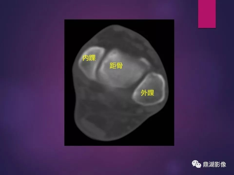 影像PPT - 【PPT】骨骼肌肉系统医学影像解剖-21