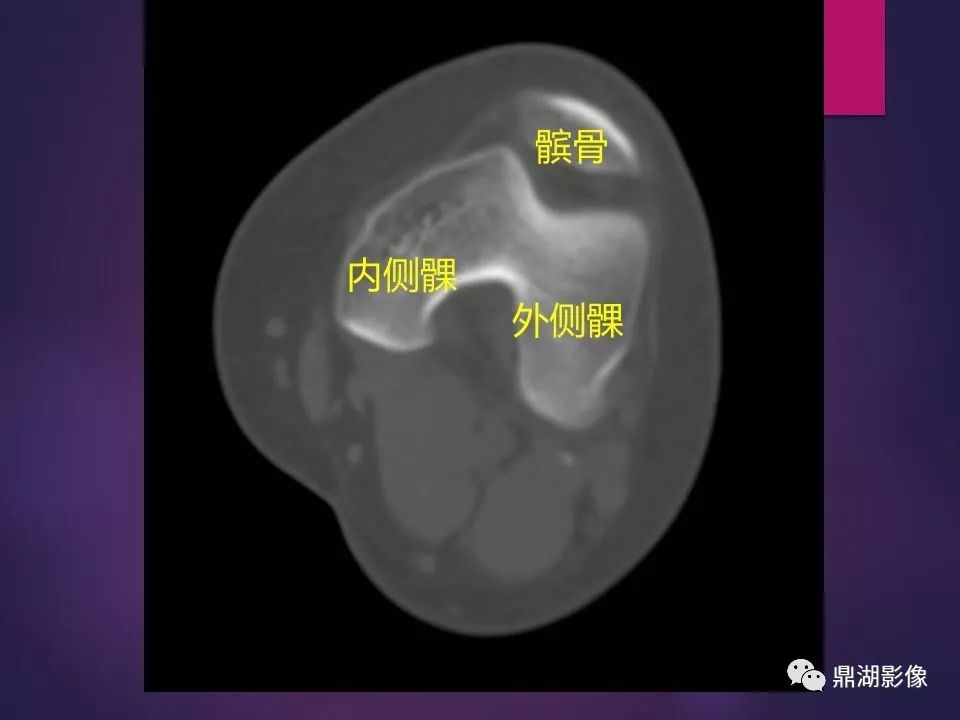 影像PPT - 【PPT】骨骼肌肉系统医学影像解剖-28