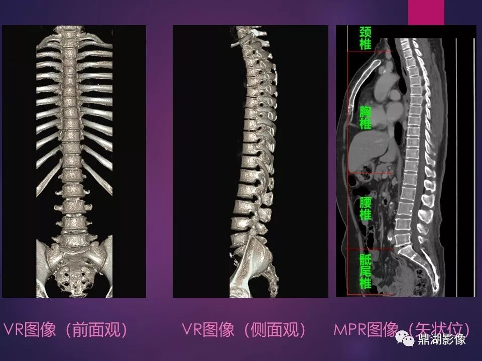 影像PPT - 【PPT】骨骼肌肉系统医学影像解剖-38