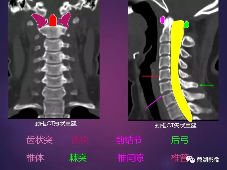 影像PPT - 【PPT】骨骼肌肉系统医学影像解剖-46