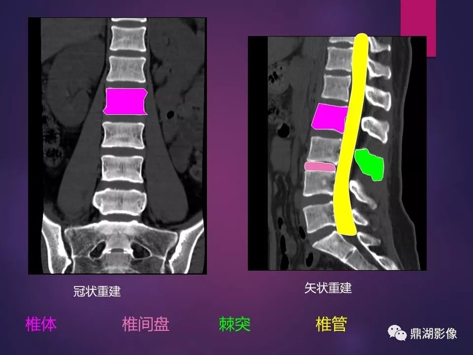 影像PPT - 【PPT】骨骼肌肉系统医学影像解剖-58
