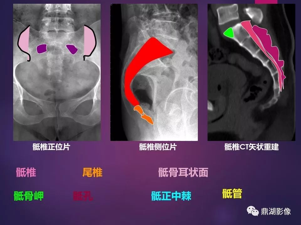 影像PPT - 【PPT】骨骼肌肉系统医学影像解剖-61