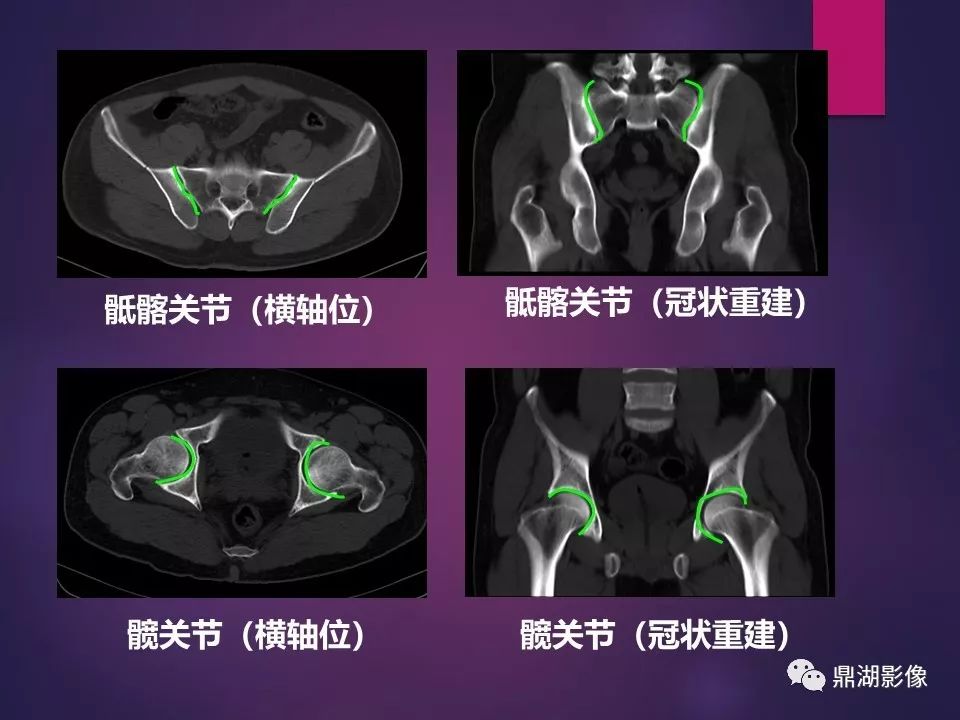 影像PPT - 【PPT】骨骼肌肉系统医学影像解剖-67