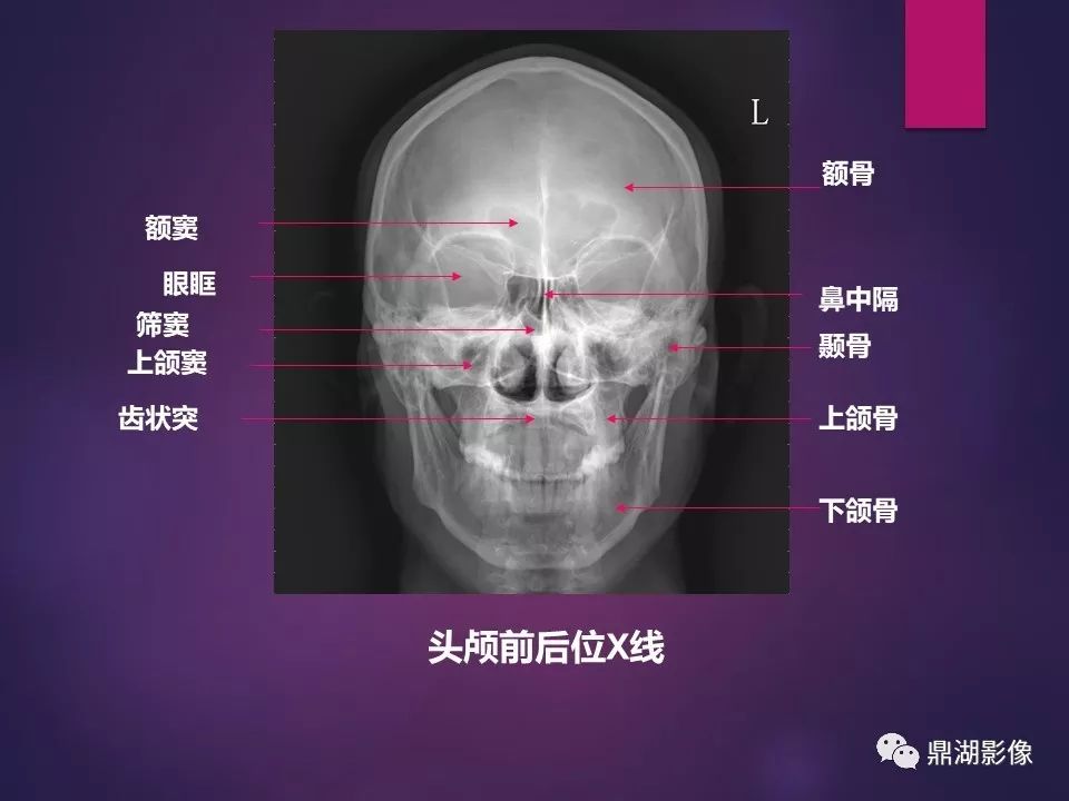 影像PPT - 【PPT】骨骼肌肉系统医学影像解剖-70