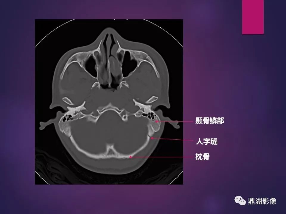 影像PPT - 【PPT】骨骼肌肉系统医学影像解剖-74