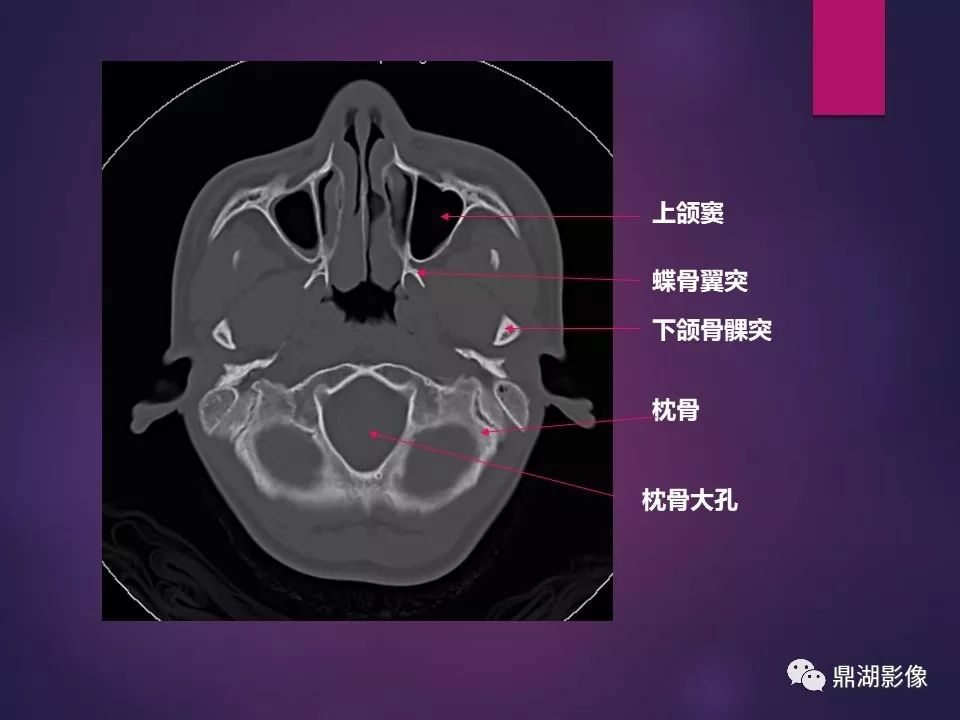 影像PPT - 【PPT】骨骼肌肉系统医学影像解剖-73