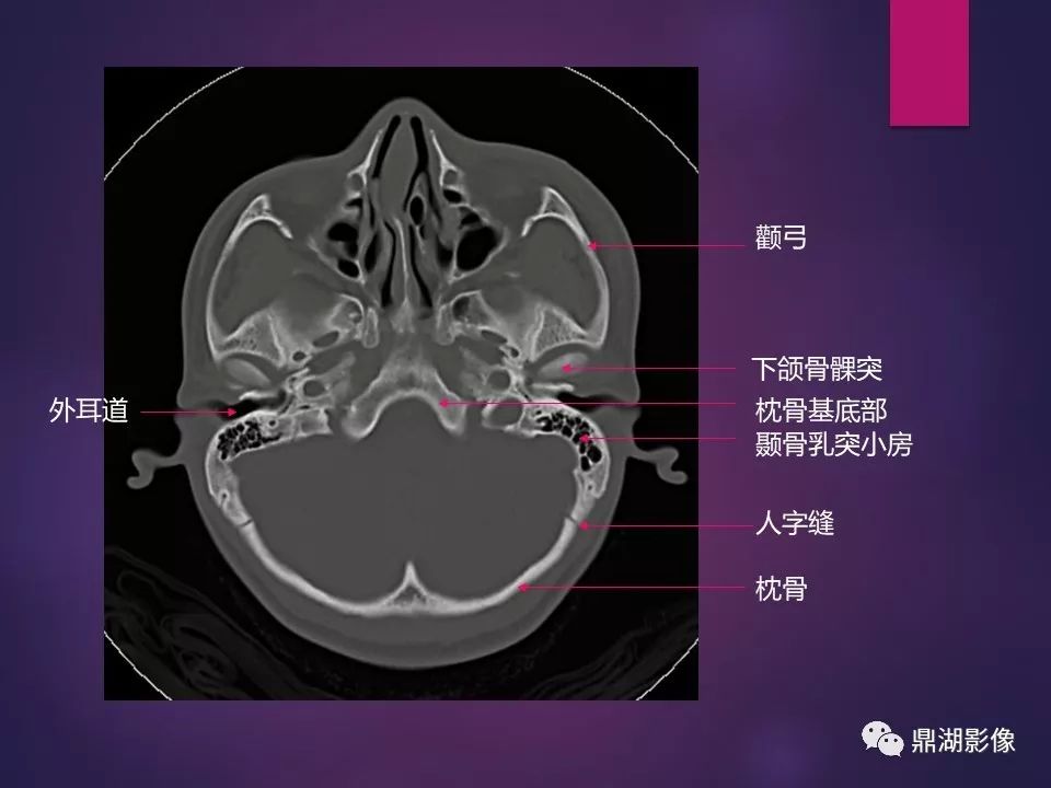 影像PPT - 【PPT】骨骼肌肉系统医学影像解剖-75