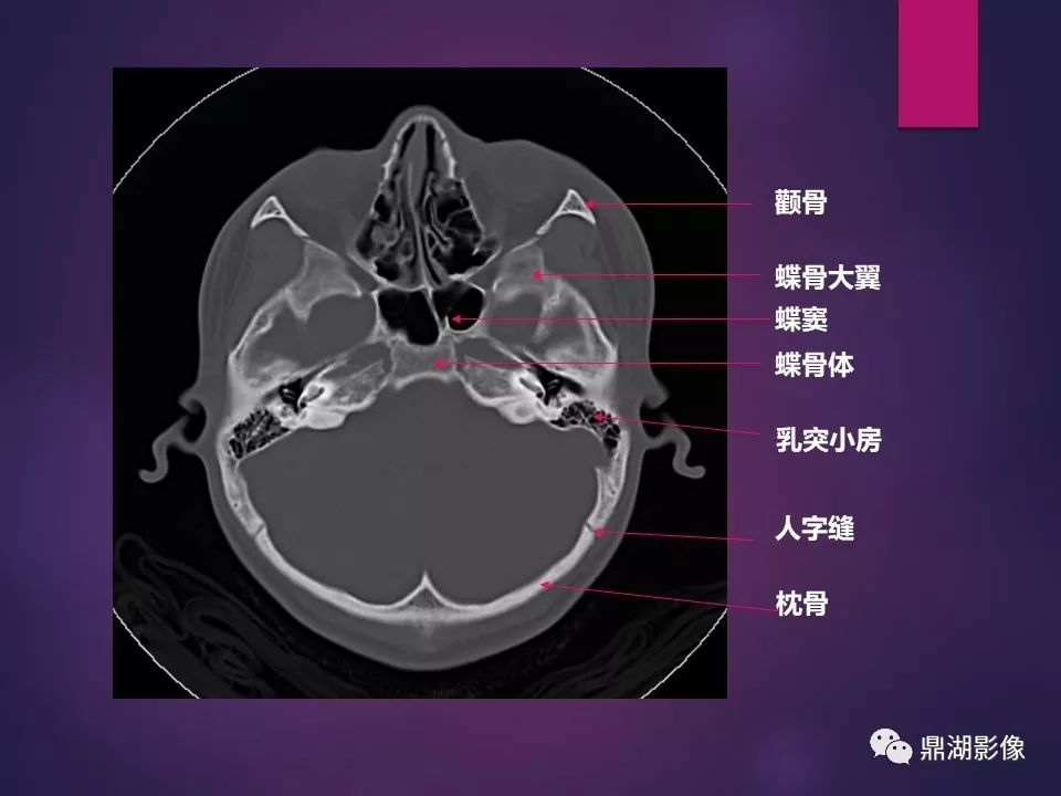 影像PPT - 【PPT】骨骼肌肉系统医学影像解剖-76