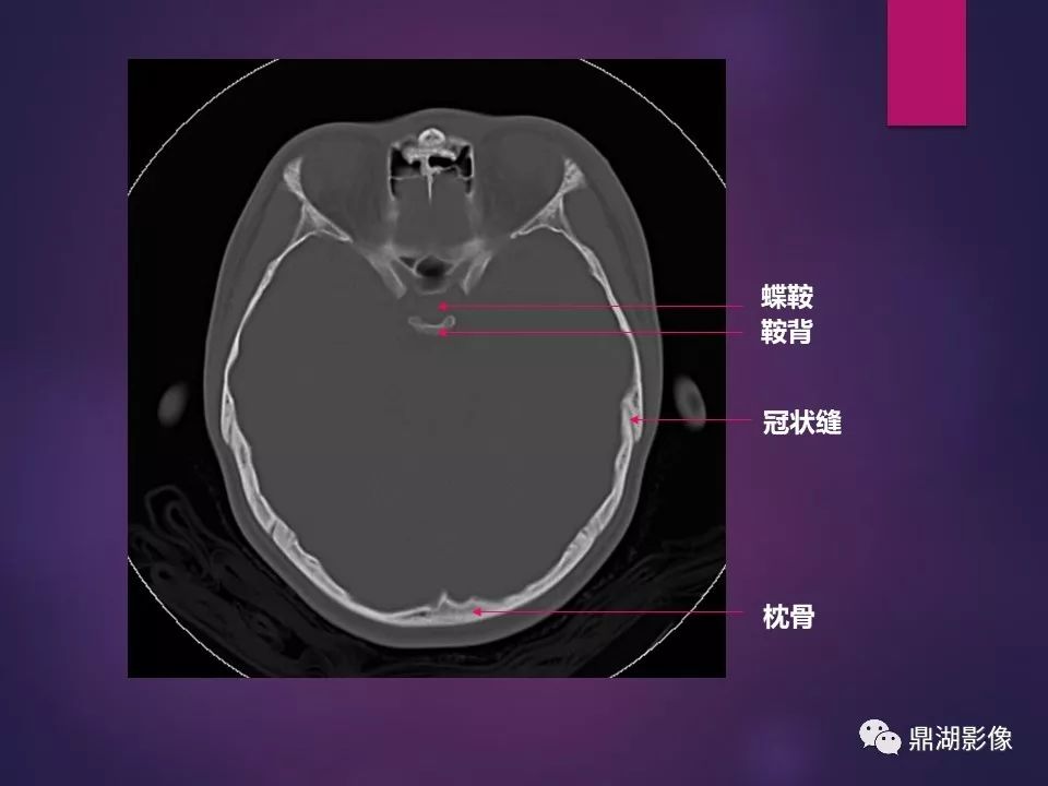 影像PPT - 【PPT】骨骼肌肉系统医学影像解剖-79