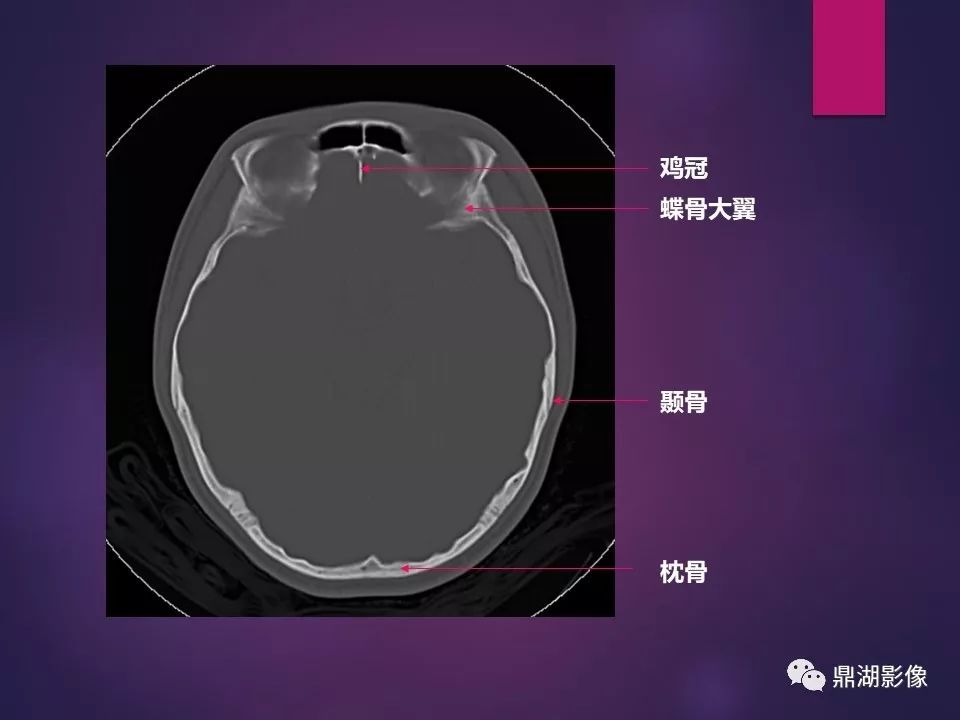 影像PPT - 【PPT】骨骼肌肉系统医学影像解剖-80