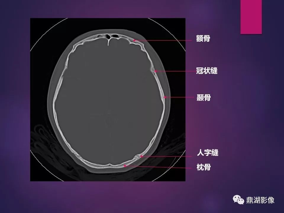 影像PPT - 【PPT】骨骼肌肉系统医学影像解剖-82