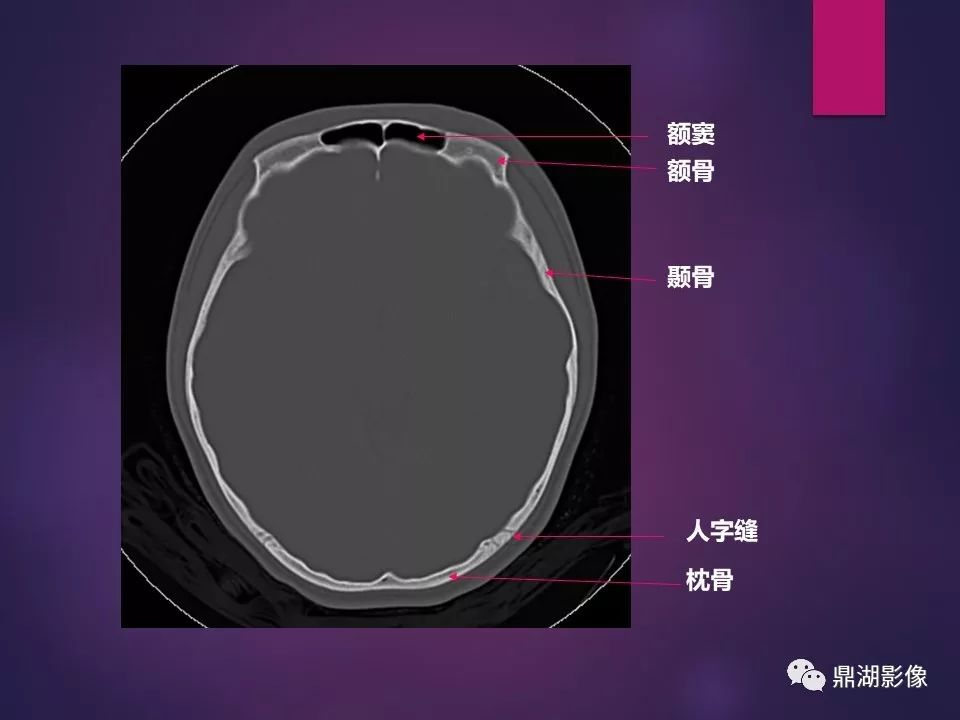 影像PPT - 【PPT】骨骼肌肉系统医学影像解剖-81