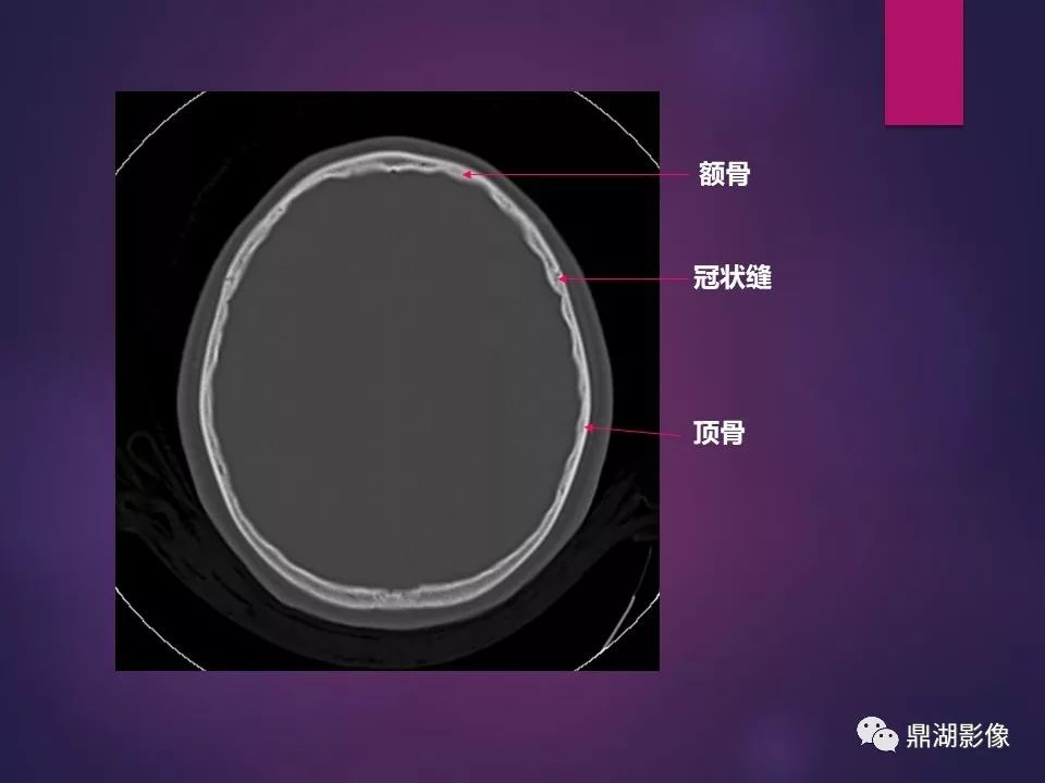 影像PPT - 【PPT】骨骼肌肉系统医学影像解剖-84