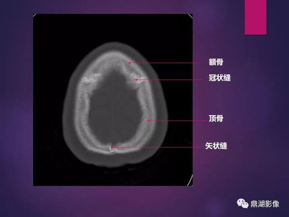 影像PPT - 【PPT】骨骼肌肉系统医学影像解剖-87