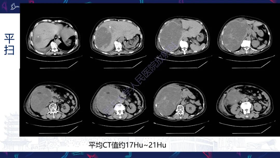 影像PPT - 【PPT】肝脏未分化胚胎性肉瘤-3
