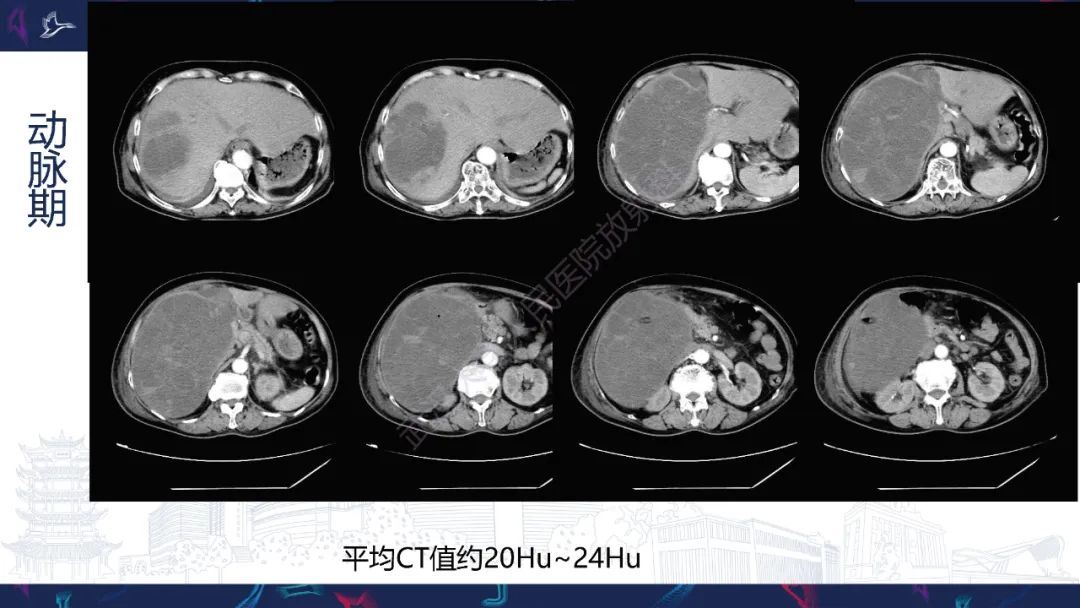 影像PPT - 【PPT】肝脏未分化胚胎性肉瘤-4