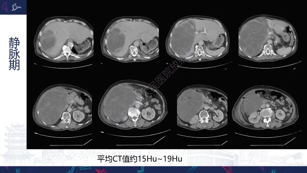 影像PPT - 【PPT】肝脏未分化胚胎性肉瘤-5
