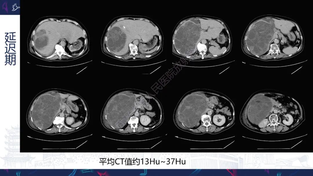 影像PPT - 【PPT】肝脏未分化胚胎性肉瘤-6