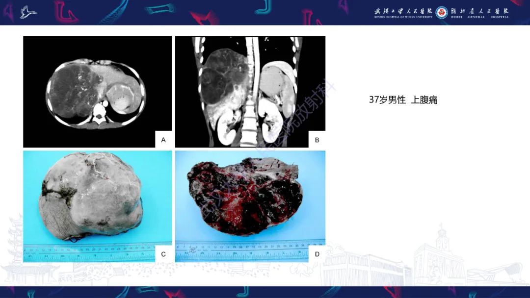 影像PPT - 【PPT】肝脏未分化胚胎性肉瘤-14