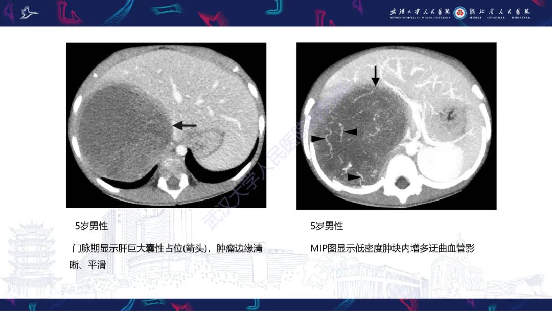 影像PPT - 【PPT】肝脏未分化胚胎性肉瘤-15