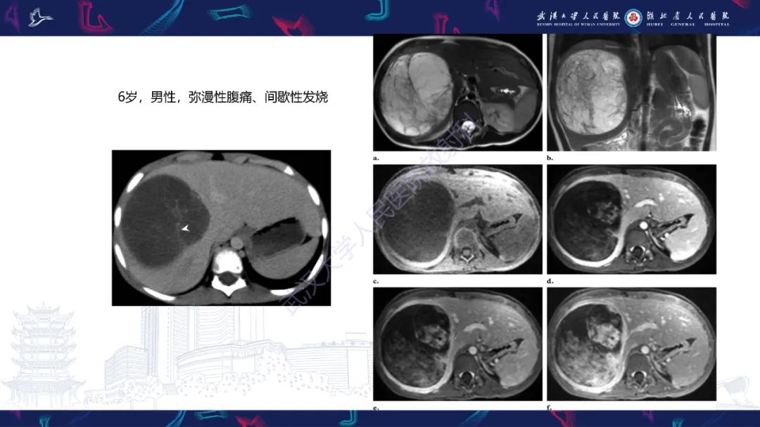 影像PPT - 【PPT】肝脏未分化胚胎性肉瘤-16