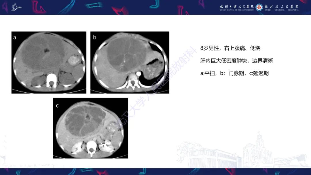 影像PPT - 【PPT】肝脏未分化胚胎性肉瘤-18