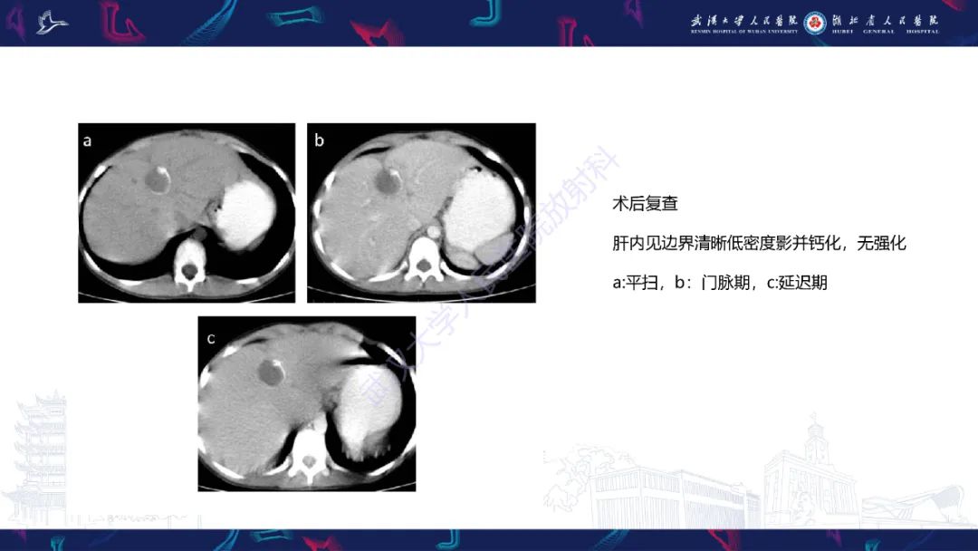 影像PPT - 【PPT】肝脏未分化胚胎性肉瘤-19