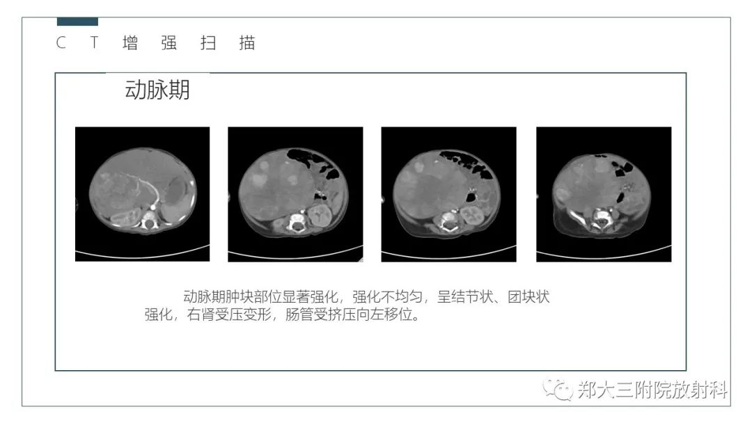 影像PPT - 【病例】肝母细胞瘤1例CT影像-5