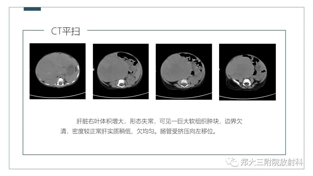 影像PPT - 【病例】肝母细胞瘤1例CT影像-4