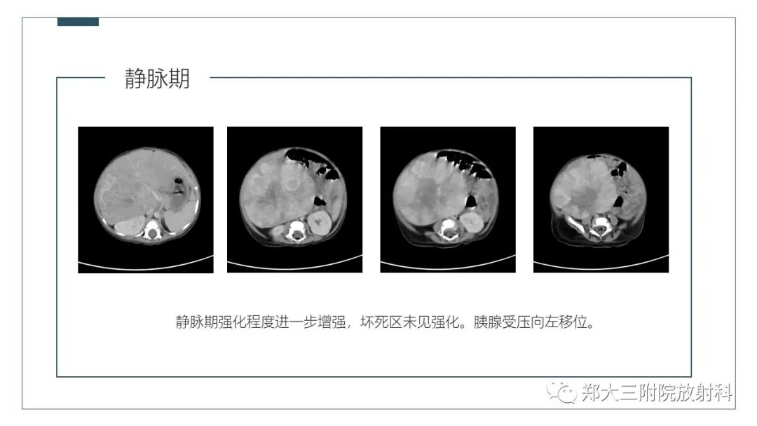 影像PPT - 【病例】肝母细胞瘤1例CT影像-6