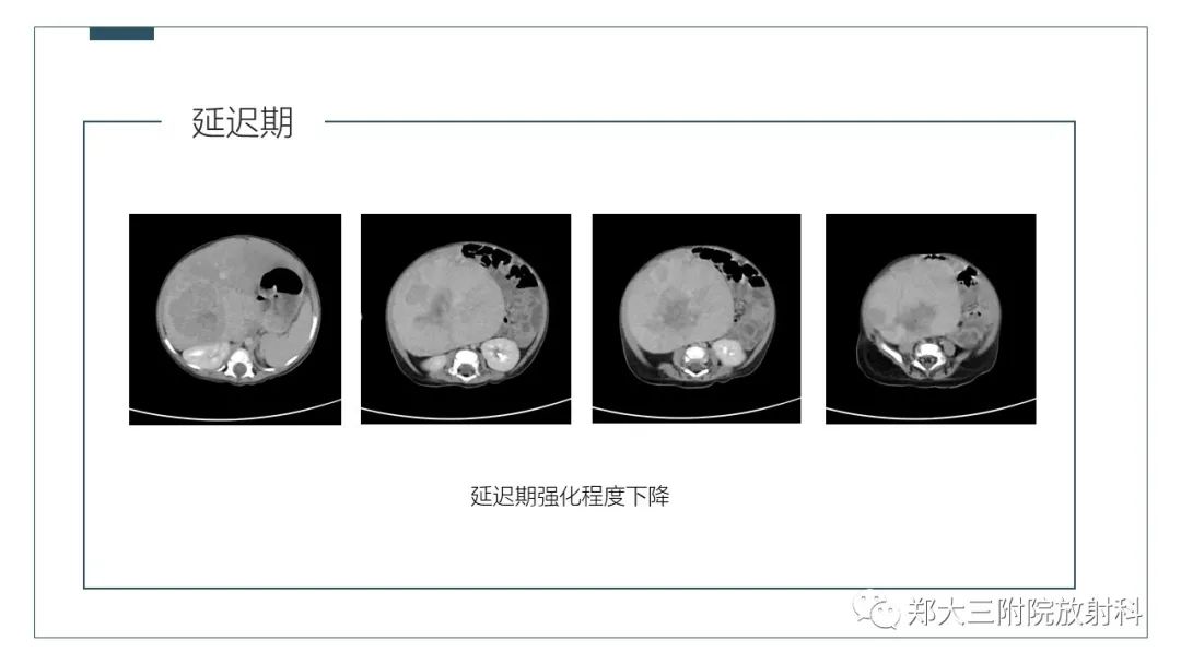 影像PPT - 【病例】肝母细胞瘤1例CT影像-7