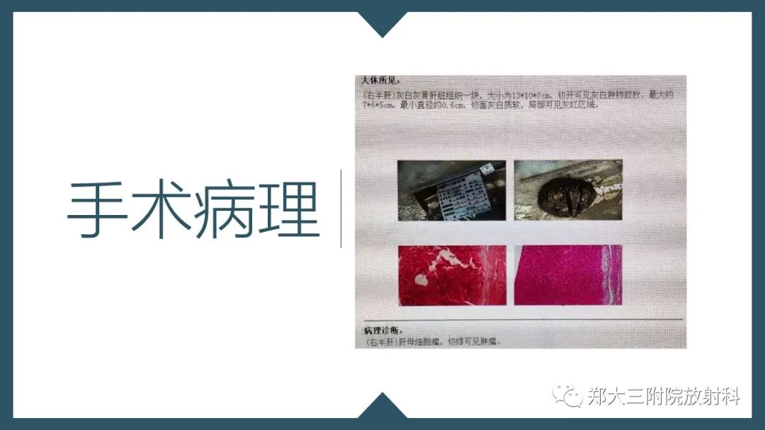 影像PPT - 【病例】肝母细胞瘤1例CT影像-10