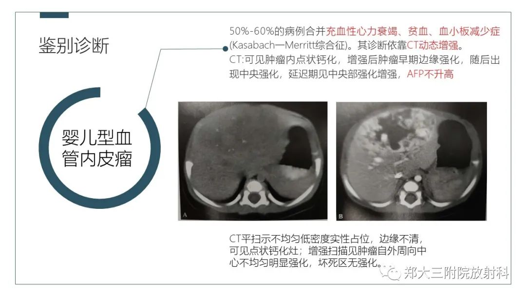 影像PPT - 【病例】肝母细胞瘤1例CT影像-19