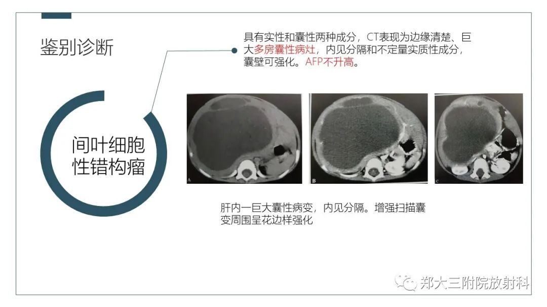 影像PPT - 【病例】肝母细胞瘤1例CT影像-16