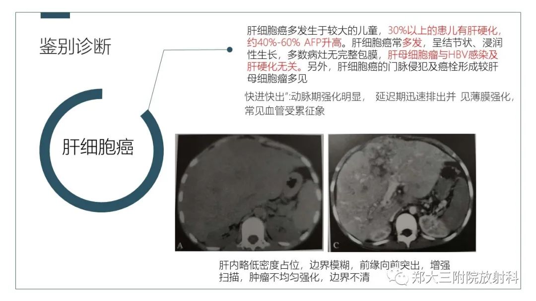 影像PPT - 【病例】肝母细胞瘤1例CT影像-17