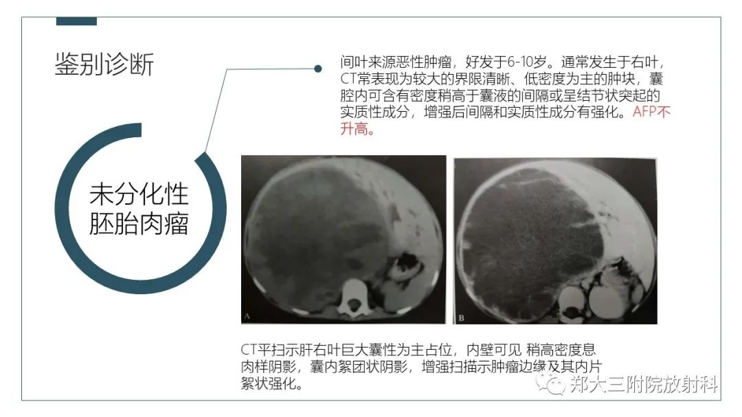 影像PPT - 【病例】肝母细胞瘤1例CT影像-18