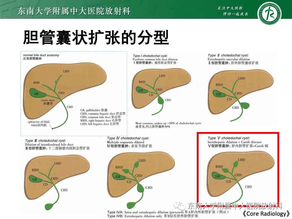 影像PPT - 【PPT】Caroli病-6