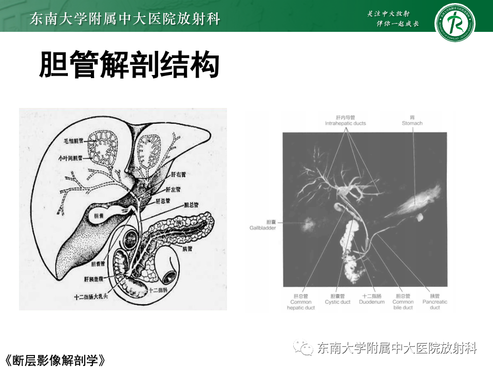 影像PPT - 【PPT】Caroli病-4