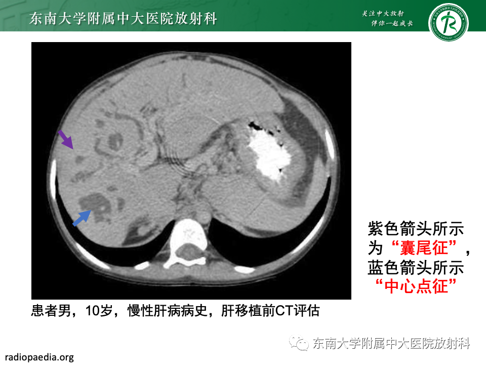 影像PPT - 【PPT】Caroli病-11