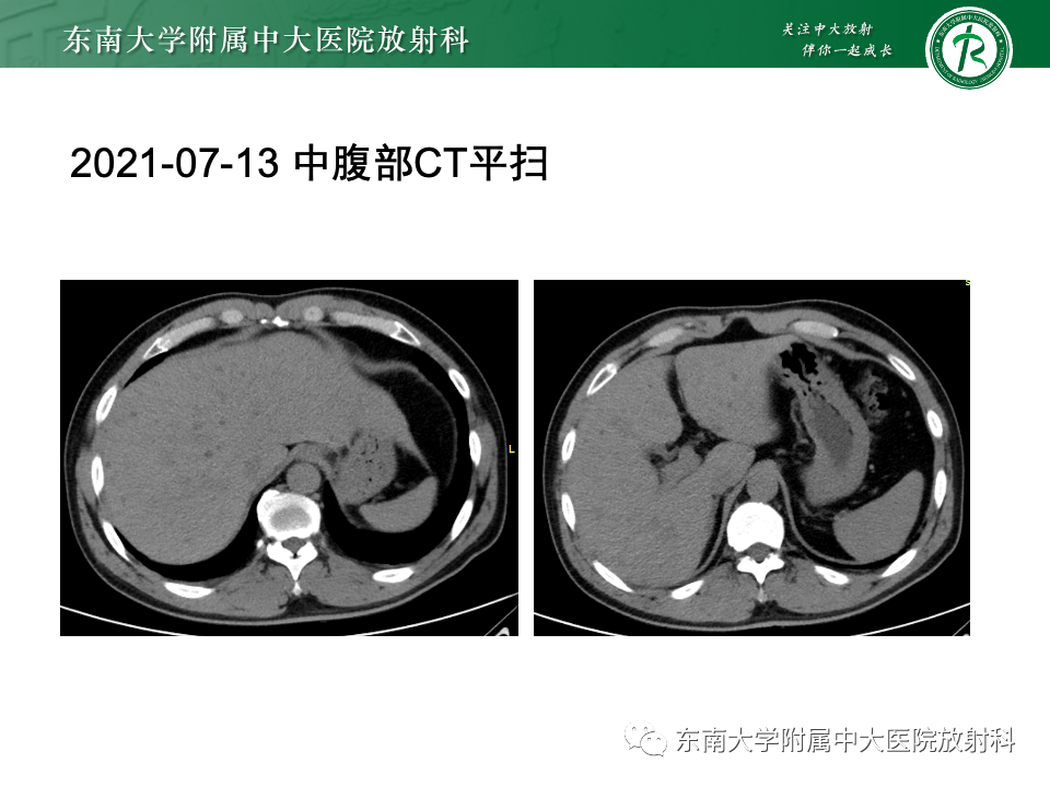 影像PPT - 【PPT】Caroli病-14