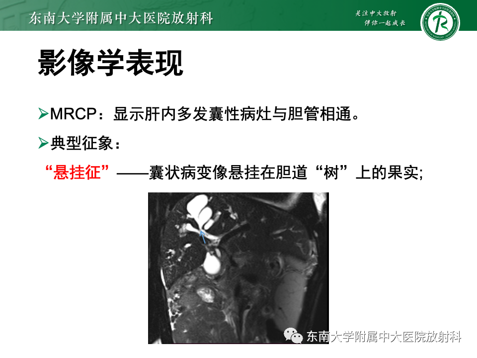 影像PPT - 【PPT】Caroli病-12