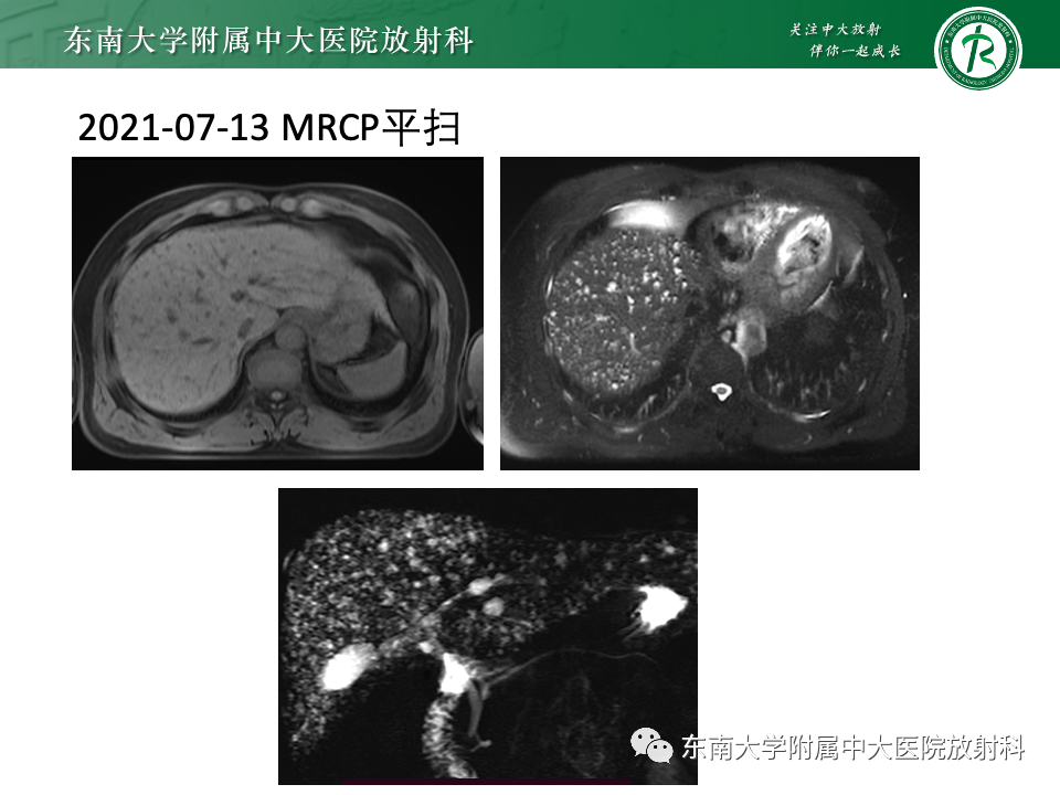 影像PPT - 【PPT】Caroli病-15