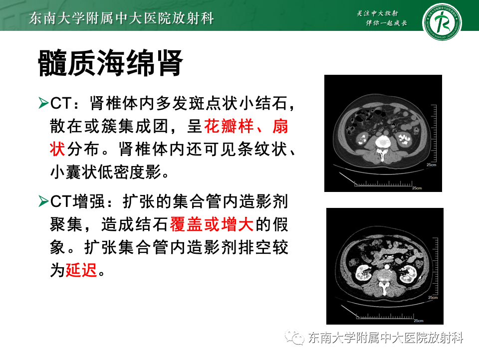 影像PPT - 【PPT】Caroli病-18