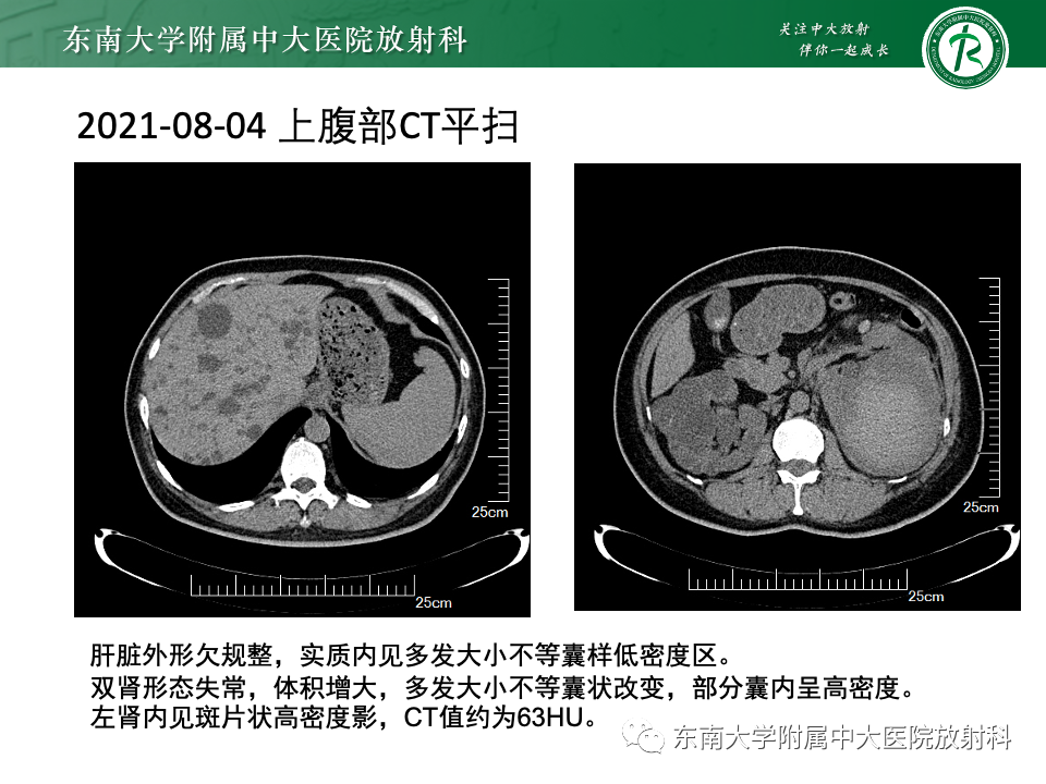 影像PPT - 【PPT】Caroli病-21