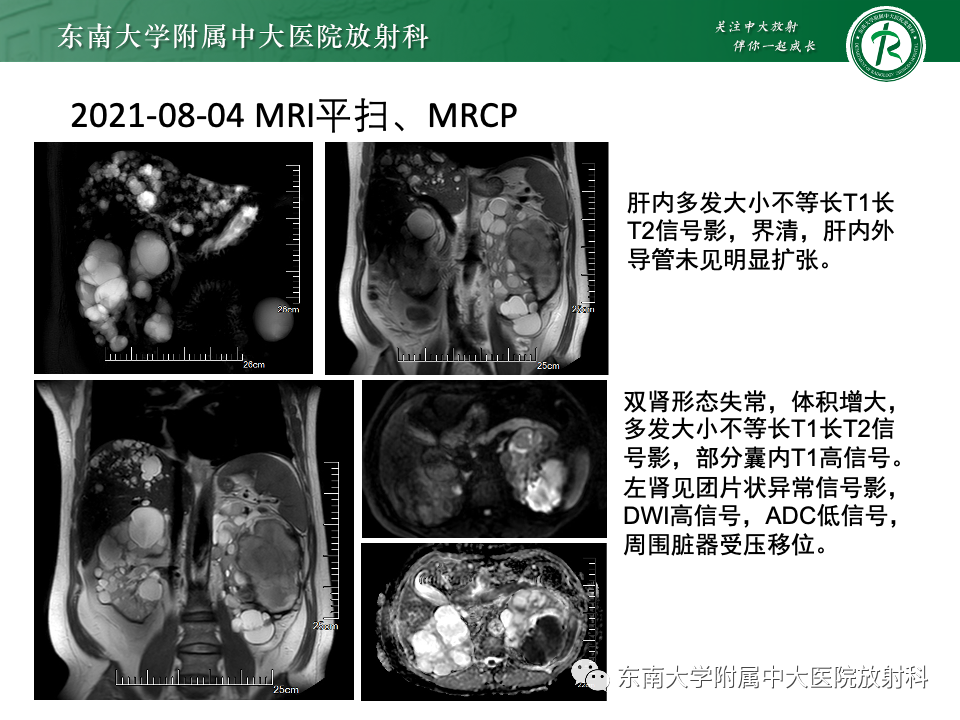 影像PPT - 【PPT】Caroli病-22